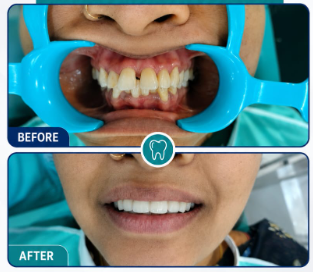 Smile Makeover Before and After