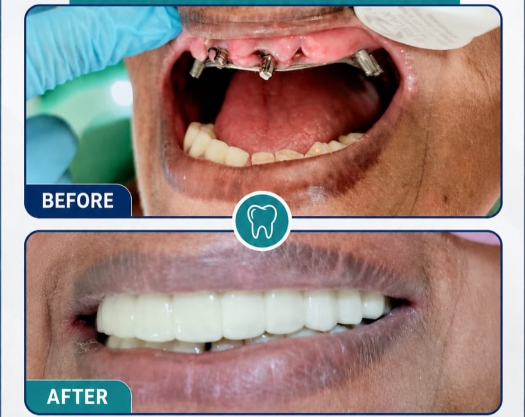 Dental Implants Before and After