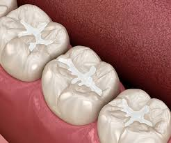 Fillings and Sealants