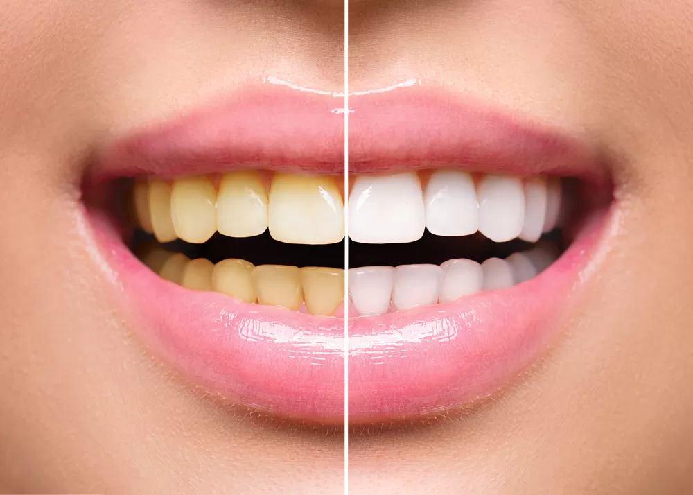 Teeth Whitening