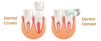 Veneers & Crowns
