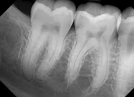 X-Ray